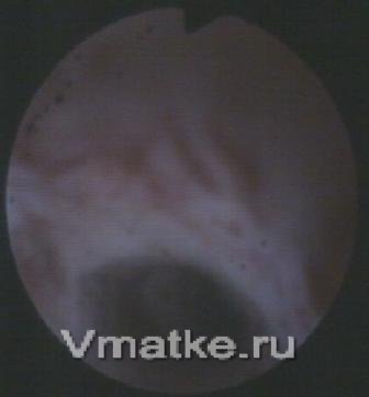 Очаги эндометриоза на стенках цервикального канала